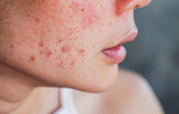 Acne & Breakouts