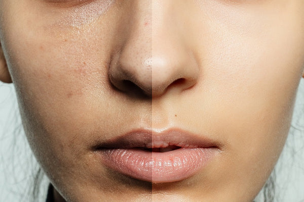 Pigmentation & Marks